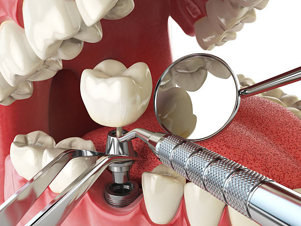 Best Emergency Broken Tooth Repair in Racend, LA